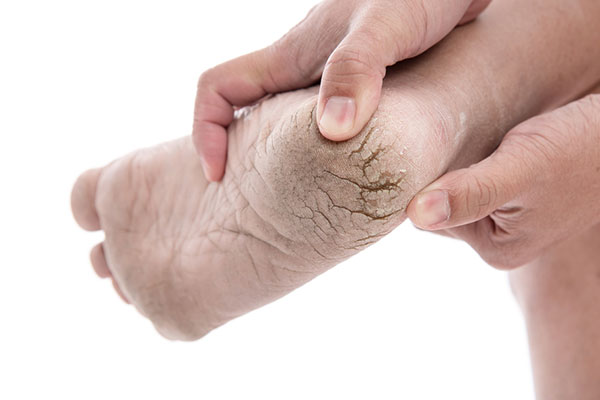 Cracked-Heel